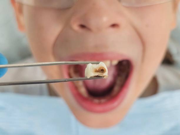 Best Emergency Broken Tooth Repair in Rtez, CO